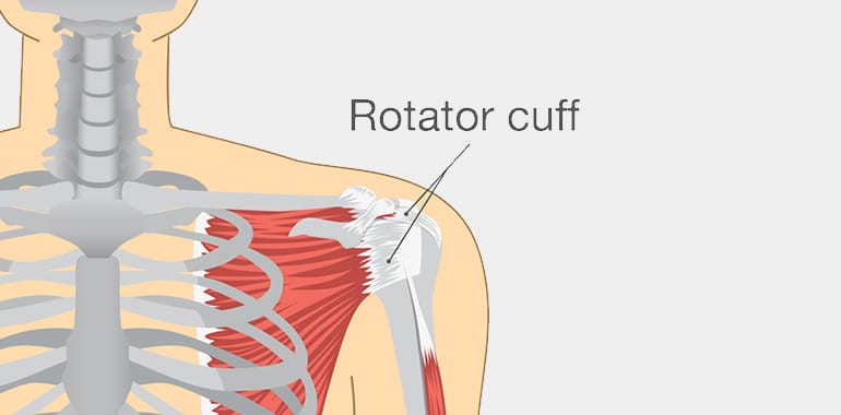 Shoulder Pain, Rotator Cuff Tears, and Surgery!